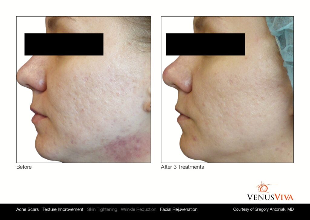 Venus Skin Resurfacing