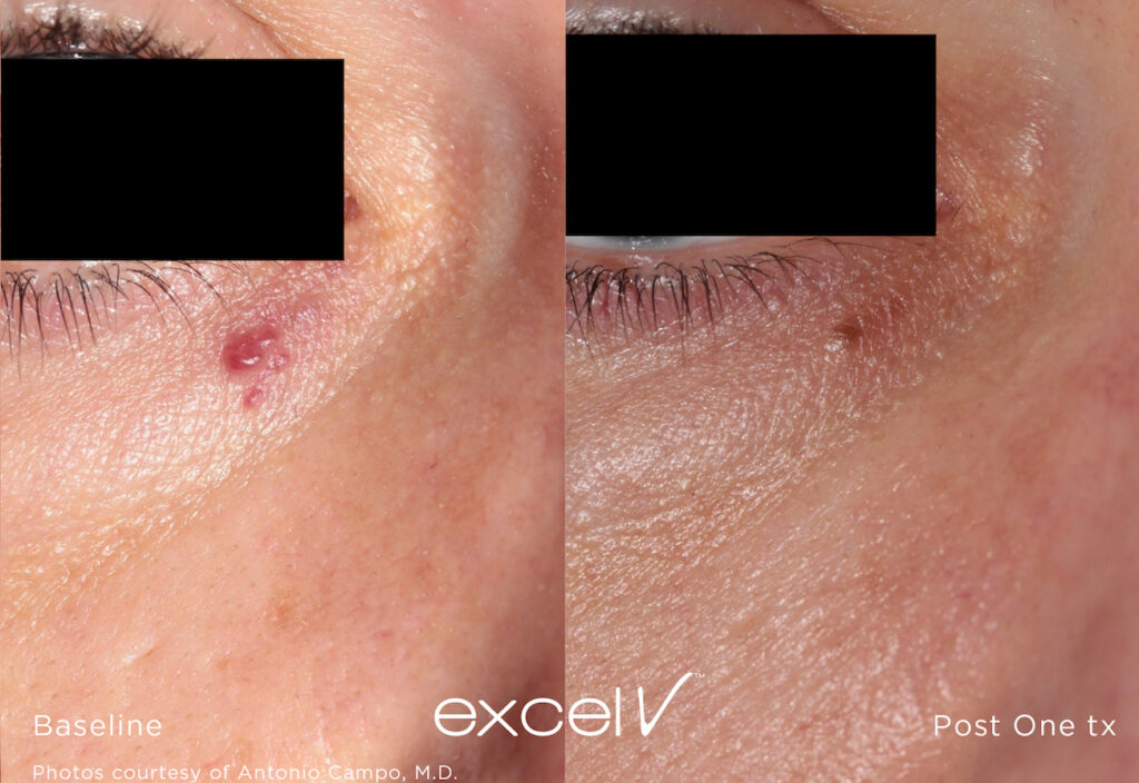 Excel V+ Bruse Fade Laser